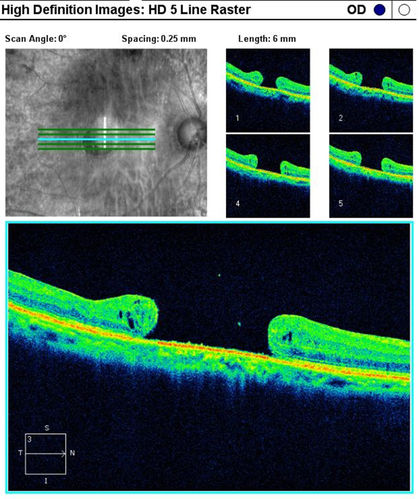 OCT Macular Hole 
Macular Hole OCT
Schlüsselwörter: OCT