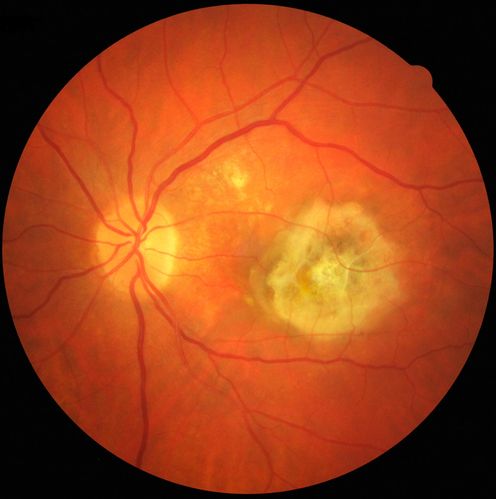 CNV outcomes
Fibrotic scar in choroidal neovascularization after anti-VEGF treatmnet
