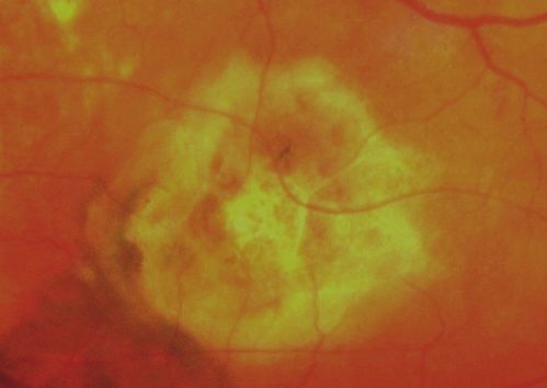 CNV outcomes
Fibrotic scar in choroidal neovascularization after  anti-VEGF treatment
