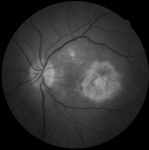 CNV outcomes
Fibrotic scar in choroidal neovascularization after anti-VEGF  treatment

