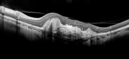 CNV outcomes
Fibrotic scar in choroidal neovascularization after anti-VEGF  treatment
