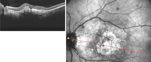 CNV outcomes
Fibrotic scar in choroidal neovascularization after anti-VEGF treatment
