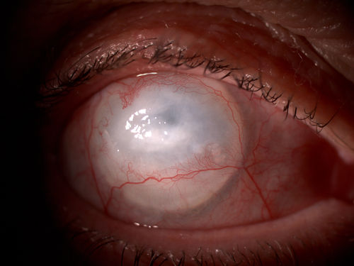 Leucoma vascolarizzato
67 female failed PKP outcome
