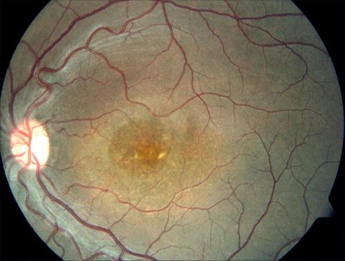 Retina.jpg