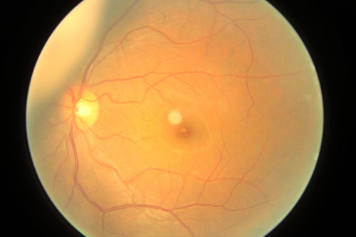 choroidal melanoma
Asian man aged 37 choroidal melanoma in left eye
Schlüsselwörter: choroidal melanoma