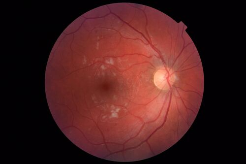Cotton Wool Spots - Severe Anemia - Acute Lymphocytic Leukemia
23 year old just diagnosed with anemia and acute lymphocytic leukemia 
: If he covers each eye neither eye is lacking.  When he looks to the left he gets double vision when he looks to the right his vision is fine.  This started about 2 weeks ago.  Since it started it has been variable.  He is on a bunch of medications for leukemia and he might be having high sugars.  He noticed the vision change after his first blood transfusion in the hospital.  He is currently very anemic.  
VA OD: sc20/20 NscJ1+
VA OS: sc20/20 NscJ1+
