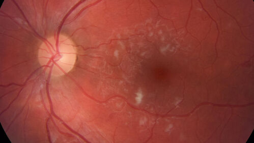 Cotton Wool Spots - Severe Anemia - Acute Lymphocytic Leukemia
23 year old just diagnosed with anemia and acute lymphocytic leukemia 
: If he covers each eye neither eye is lacking.  When he looks to the left he gets double vision when he looks to the right his vision is fine.  This started about 2 weeks ago.  Since it started it has been variable.  He is on a bunch of medications for leukemia and he might be having high sugars.  He noticed the vision change after his first blood transfusion in the hospital.  He is currently very anemic.  
VA OD: sc20/20 NscJ1+
VA OS: sc20/20 NscJ1+
