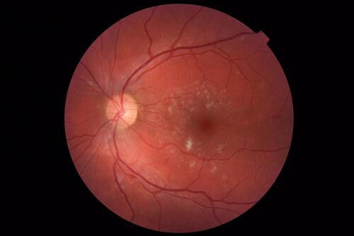 Cotton Wool Spots - Severe Anemia - Acute Lymphocytic Leukemia
23 year old just diagnosed with anemia and acute lymphocytic leukemia 
: If he covers each eye neither eye is lacking.  When he looks to the left he gets double vision when he looks to the right his vision is fine.  This started about 2 weeks ago.  Since it started it has been variable.  He is on a bunch of medications for leukemia and he might be having high sugars.  He noticed the vision change after his first blood transfusion in the hospital.  He is currently very anemic.  
VA OD: sc20/20 NscJ1+
VA OS: sc20/20 NscJ1+
