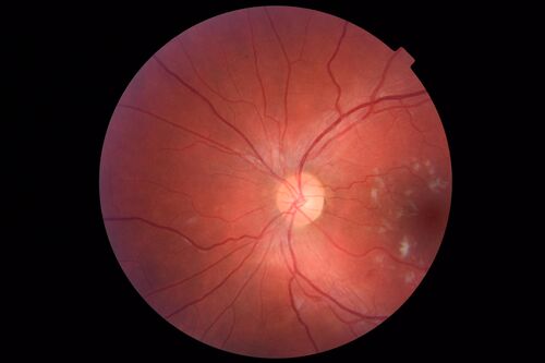 Cotton Wool Spots - Severe Anemia - Acute Lymphocytic Leukemia
23 year old just diagnosed with anemia and acute lymphocytic leukemia 
: If he covers each eye neither eye is lacking.  When he looks to the left he gets double vision when he looks to the right his vision is fine.  This started about 2 weeks ago.  Since it started it has been variable.  He is on a bunch of medications for leukemia and he might be having high sugars.  He noticed the vision change after his first blood transfusion in the hospital.  He is currently very anemic.  
VA OD: sc20/20 NscJ1+
VA OS: sc20/20 NscJ1+
