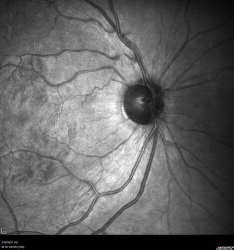 Cotton Wool Spots - Severe Anemia - Acute Lymphocytic Leukemia
23 year old just diagnosed with anemia and acute lymphocytic leukemia 
: If he covers each eye neither eye is lacking.  When he looks to the left he gets double vision when he looks to the right his vision is fine.  This started about 2 weeks ago.  Since it started it has been variable.  He is on a bunch of medications for leukemia and he might be having high sugars.  He noticed the vision change after his first blood transfusion in the hospital.  He is currently very anemic.  
VA OD: sc20/20 NscJ1+
VA OS: sc20/20 NscJ1+
