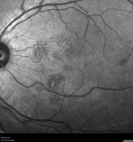 Cotton Wool Spots - Severe Anemia - Acute Lymphocytic Leukemia
23 year old just diagnosed with anemia and acute lymphocytic leukemia 
: If he covers each eye neither eye is lacking.  When he looks to the left he gets double vision when he looks to the right his vision is fine.  This started about 2 weeks ago.  Since it started it has been variable.  He is on a bunch of medications for leukemia and he might be having high sugars.  He noticed the vision change after his first blood transfusion in the hospital.  He is currently very anemic.  
VA OD: sc20/20 NscJ1+
VA OS: sc20/20 NscJ1+
