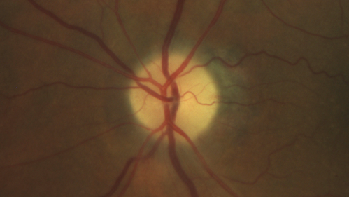 optic atrophy
64 year old man with painless sequential vision loss in both eyes 20 years ago.  Possibly LHON or AION.
VA OD: sc20/80 PH20/63 NscJ16
VA OS: sc20/200-2 PHNI Nsc20/800
