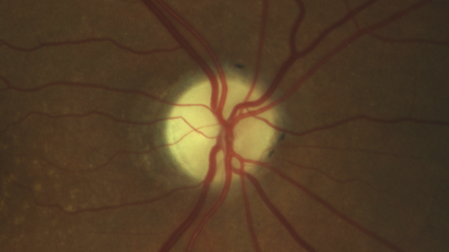 optic atrophy
64 year old man with painless sequential vision loss in both eyes 20 years ago.  Possibly LHON or AION.
VA OD: sc20/80 PH20/63 NscJ16
VA OS: sc20/200-2 PHNI Nsc20/800
