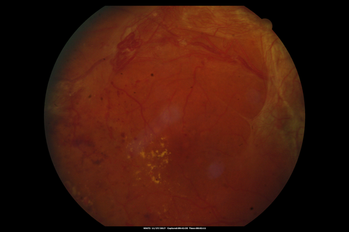 Traction retinal detachment both eyes.  Proliferative Diabetic Retinopathy
40 year old man came in with vision loss OD and rubeosis in both eyes.  Was treated with Avastin monthly and laser OD then lost to follow-up for 6 months.  Came back with table top traction in the left macula (second set of images).  Vision had dropped OS from 20/20 to HM.  He had PPV ERM peel OS and vision improved to 5/200.  
OD stabilized to 20/20 with PRP laser.  Now on 6 month checks.
