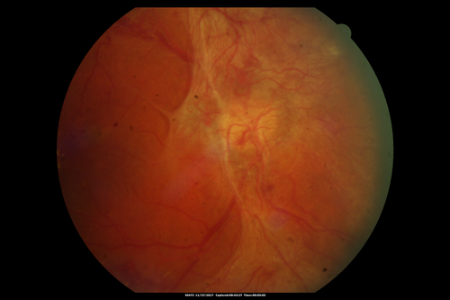 Traction retinal detachment both eyes.  Proliferative Diabetic Retinopathy
40 year old man came in with vision loss OD and rubeosis in both eyes.  Was treated with Avastin monthly and laser OD then lost to follow-up for 6 months.  Came back with table top traction in the left macula (second set of images).  Vision had dropped OS from 20/20 to HM.  He had PPV ERM peel OS and vision improved to 5/200.  
OD stabilized to 20/20 with PRP laser.  Now on 6 month checks.
