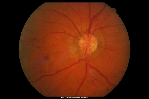 Traction retinal detachment both eyes.  Proliferative Diabetic Retinopathy
40 year old man came in with vision loss OD and rubeosis in both eyes.  Was treated with Avastin monthly and laser OD then lost to follow-up for 6 months.  Came back with table top traction in the left macula (second set of images).  Vision had dropped OS from 20/20 to HM.  He had PPV ERM peel OS and vision improved to 5/200.  
OD stabilized to 20/20 with PRP laser.  Now on 6 month checks.
