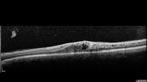 Traction retinal detachment both eyes.  Proliferative Diabetic Retinopathy
40 year old man came in with vision loss OD and rubeosis in both eyes.  Was treated with Avastin monthly and laser OD then lost to follow-up for 6 months.  Came back with table top traction in the left macula (second set of images).  Vision had dropped OS from 20/20 to HM.  He had PPV ERM peel OS and vision improved to 5/200.  
OD stabilized to 20/20 with PRP laser.  Now on 6 month checks.
