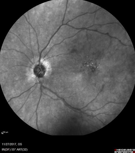 Traction retinal detachment both eyes.  Proliferative Diabetic Retinopathy
40 year old man came in with vision loss OD and rubeosis in both eyes.  Was treated with Avastin monthly and laser OD then lost to follow-up for 6 months.  Came back with table top traction in the left macula (second set of images).  Vision had dropped OS from 20/20 to HM.  He had PPV ERM peel OS and vision improved to 5/200.  
OD stabilized to 20/20 with PRP laser.  Now on 6 month checks.
