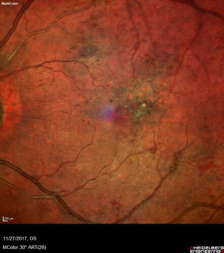Traction retinal detachment both eyes.  Proliferative Diabetic Retinopathy
40 year old man came in with vision loss OD and rubeosis in both eyes.  Was treated with Avastin monthly and laser OD then lost to follow-up for 6 months.  Came back with table top traction in the left macula (second set of images).  Vision had dropped OS from 20/20 to HM.  He had PPV ERM peel OS and vision improved to 5/200.  
OD stabilized to 20/20 with PRP laser.  Now on 6 month checks.
