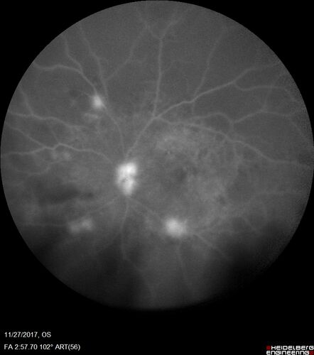 Traction retinal detachment both eyes.  Proliferative Diabetic Retinopathy
40 year old man came in with vision loss OD and rubeosis in both eyes.  Was treated with Avastin monthly and laser OD then lost to follow-up for 6 months.  Came back with table top traction in the left macula (second set of images).  Vision had dropped OS from 20/20 to HM.  He had PPV ERM peel OS and vision improved to 5/200.  
OD stabilized to 20/20 with PRP laser.  Now on 6 month checks.
