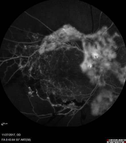 Traction retinal detachment both eyes.  Proliferative Diabetic Retinopathy
40 year old man came in with vision loss OD and rubeosis in both eyes.  Was treated with Avastin monthly and laser OD then lost to follow-up for 6 months.  Came back with table top traction in the left macula (second set of images).  Vision had dropped OS from 20/20 to HM.  He had PPV ERM peel OS and vision improved to 5/200.  
OD stabilized to 20/20 with PRP laser.  Now on 6 month checks.
