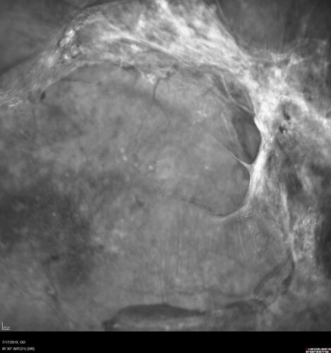 Traction retinal detachment both eyes.  Proliferative Diabetic Retinopathy
40 year old man came in with vision loss OD and rubeosis in both eyes.  Was treated with Avastin monthly and laser OD then lost to follow-up for 6 months.  Came back with table top traction in the left macula (second set of images).  Vision had dropped OS from 20/20 to HM.  He had PPV ERM peel OS and vision improved to 5/200.  
OD stabilized to 20/20 with PRP laser.  Now on 6 month checks.
