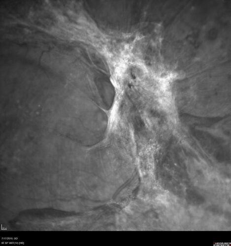 Traction retinal detachment both eyes.  Proliferative Diabetic Retinopathy
40 year old man came in with vision loss OD and rubeosis in both eyes.  Was treated with Avastin monthly and laser OD then lost to follow-up for 6 months.  Came back with table top traction in the left macula (second set of images).  Vision had dropped OS from 20/20 to HM.  He had PPV ERM peel OS and vision improved to 5/200.  
OD stabilized to 20/20 with PRP laser.  Now on 6 month checks.
