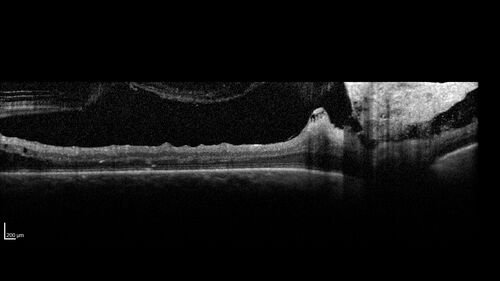 Traction retinal detachment both eyes.  Proliferative Diabetic Retinopathy
40 year old man came in with vision loss OD and rubeosis in both eyes.  Was treated with Avastin monthly and laser OD then lost to follow-up for 6 months.  Came back with table top traction in the left macula (second set of images).  Vision had dropped OS from 20/20 to HM.  He had PPV ERM peel OS and vision improved to 5/200.  
OD stabilized to 20/20 with PRP laser.  Now on 6 month checks.
