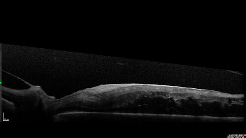 Traction retinal detachment both eyes.  Proliferative Diabetic Retinopathy
40 year old man came in with vision loss OD and rubeosis in both eyes.  Was treated with Avastin monthly and laser OD then lost to follow-up for 6 months.  Came back with table top traction in the left macula (second set of images).  Vision had dropped OS from 20/20 to HM.  He had PPV ERM peel OS and vision improved to 5/200.  
OD stabilized to 20/20 with PRP laser.  Now on 6 month checks.
