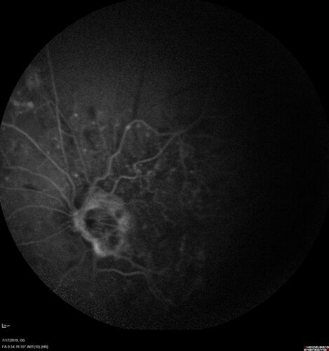 Traction retinal detachment both eyes.  Proliferative Diabetic Retinopathy
40 year old man came in with vision loss OD and rubeosis in both eyes.  Was treated with Avastin monthly and laser OD then lost to follow-up for 6 months.  Came back with table top traction in the left macula (second set of images).  Vision had dropped OS from 20/20 to HM.  He had PPV ERM peel OS and vision improved to 5/200.  
OD stabilized to 20/20 with PRP laser.  Now on 6 month checks.
