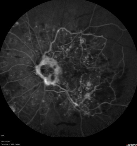 Traction retinal detachment both eyes.  Proliferative Diabetic Retinopathy
40 year old man came in with vision loss OD and rubeosis in both eyes.  Was treated with Avastin monthly and laser OD then lost to follow-up for 6 months.  Came back with table top traction in the left macula (second set of images).  Vision had dropped OS from 20/20 to HM.  He had PPV ERM peel OS and vision improved to 5/200.  
OD stabilized to 20/20 with PRP laser.  Now on 6 month checks.
