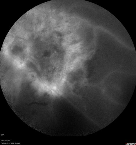 Traction retinal detachment both eyes.  Proliferative Diabetic Retinopathy
40 year old man came in with vision loss OD and rubeosis in both eyes.  Was treated with Avastin monthly and laser OD then lost to follow-up for 6 months.  Came back with table top traction in the left macula (second set of images).  Vision had dropped OS from 20/20 to HM.  He had PPV ERM peel OS and vision improved to 5/200.  
OD stabilized to 20/20 with PRP laser.  Now on 6 month checks.
