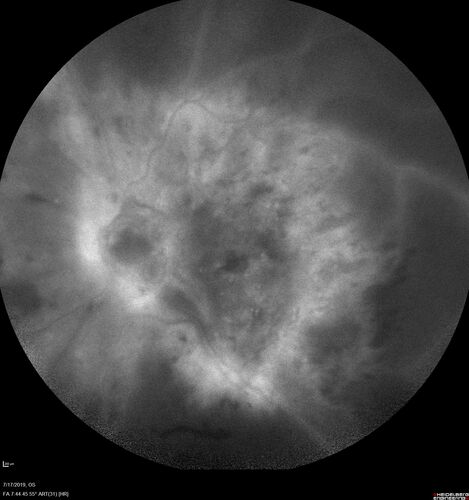 Traction retinal detachment both eyes.  Proliferative Diabetic Retinopathy
40 year old man came in with vision loss OD and rubeosis in both eyes.  Was treated with Avastin monthly and laser OD then lost to follow-up for 6 months.  Came back with table top traction in the left macula (second set of images).  Vision had dropped OS from 20/20 to HM.  He had PPV ERM peel OS and vision improved to 5/200.  
OD stabilized to 20/20 with PRP laser.  Now on 6 month checks.
