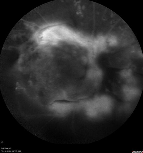 Traction retinal detachment both eyes.  Proliferative Diabetic Retinopathy
40 year old man came in with vision loss OD and rubeosis in both eyes.  Was treated with Avastin monthly and laser OD then lost to follow-up for 6 months.  Came back with table top traction in the left macula (second set of images).  Vision had dropped OS from 20/20 to HM.  He had PPV ERM peel OS and vision improved to 5/200.  
OD stabilized to 20/20 with PRP laser.  Now on 6 month checks.
