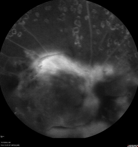 Traction retinal detachment both eyes.  Proliferative Diabetic Retinopathy
40 year old man came in with vision loss OD and rubeosis in both eyes.  Was treated with Avastin monthly and laser OD then lost to follow-up for 6 months.  Came back with table top traction in the left macula (second set of images).  Vision had dropped OS from 20/20 to HM.  He had PPV ERM peel OS and vision improved to 5/200.  
OD stabilized to 20/20 with PRP laser.  Now on 6 month checks.
