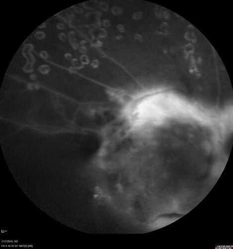 Traction retinal detachment both eyes.  Proliferative Diabetic Retinopathy
40 year old man came in with vision loss OD and rubeosis in both eyes.  Was treated with Avastin monthly and laser OD then lost to follow-up for 6 months.  Came back with table top traction in the left macula (second set of images).  Vision had dropped OS from 20/20 to HM.  He had PPV ERM peel OS and vision improved to 5/200.  
OD stabilized to 20/20 with PRP laser.  Now on 6 month checks.
