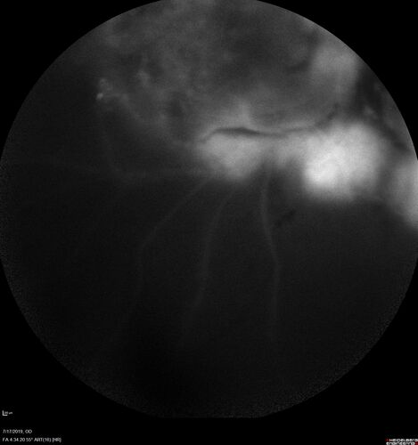 Traction retinal detachment both eyes.  Proliferative Diabetic Retinopathy
40 year old man came in with vision loss OD and rubeosis in both eyes.  Was treated with Avastin monthly and laser OD then lost to follow-up for 6 months.  Came back with table top traction in the left macula (second set of images).  Vision had dropped OS from 20/20 to HM.  He had PPV ERM peel OS and vision improved to 5/200.  
OD stabilized to 20/20 with PRP laser.  Now on 6 month checks.
