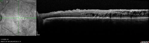 Traction retinal detachment both eyes.  Proliferative Diabetic Retinopathy
40 year old man came in with vision loss OD and rubeosis in both eyes.  Was treated with Avastin monthly and laser OD then lost to follow-up for 6 months.  Came back with table top traction in the left macula (second set of images).  Vision had dropped OS from 20/20 to HM.  He had PPV ERM peel OS and vision improved to 5/200.  
OD stabilized to 20/20 with PRP laser.  Now on 6 month checks.
