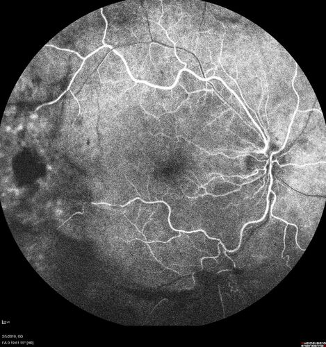 PDR and Vitreous hemorrhage - Second FA is following PRP laser
42 year old man (date 2018): Prior to 2 months ago the vision in the right eye was good.  This started with a glob in the vision and then the vision got better.  Then the string came back down and is getting bigger and bigger.  The last time he had bleeding in the left eye he had surgery in 2009.  The left eye is now doing OK other than there is a cataract.  The right eye had some laser treatment done in 2009.  The vitrectomy and laser were done at William Beaumont.  
VA OD: sc3'/200 NscUnable
VA OS: sc20/40 NscJ2-1
