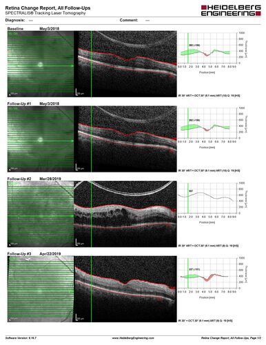 PDR and Vitreous hemorrhage - Second FA is following PRP laser
42 year old man (date 2018): Prior to 2 months ago the vision in the right eye was good.  This started with a glob in the vision and then the vision got better.  Then the string came back down and is getting bigger and bigger.  The last time he had bleeding in the left eye he had surgery in 2009.  The left eye is now doing OK other than there is a cataract.  The right eye had some laser treatment done in 2009.  The vitrectomy and laser were done at William Beaumont.  
VA OD: sc3'/200 NscUnable
VA OS: sc20/40 NscJ2-1
