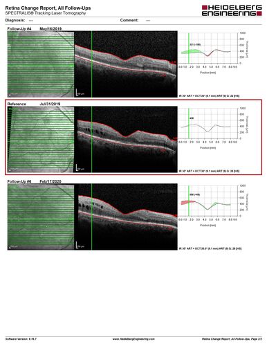 PDR and Vitreous hemorrhage - Second FA is following PRP laser
42 year old man (date 2018): Prior to 2 months ago the vision in the right eye was good.  This started with a glob in the vision and then the vision got better.  Then the string came back down and is getting bigger and bigger.  The last time he had bleeding in the left eye he had surgery in 2009.  The left eye is now doing OK other than there is a cataract.  The right eye had some laser treatment done in 2009.  The vitrectomy and laser were done at William Beaumont.  
VA OD: sc3'/200 NscUnable
VA OS: sc20/40 NscJ2-1
