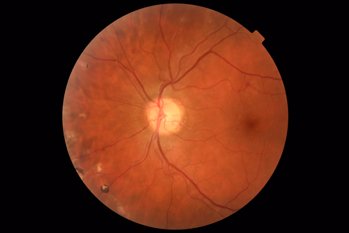PDR and Vitreous hemorrhage - Second FA is following PRP laser
42 year old man (date 2018): Prior to 2 months ago the vision in the right eye was good.  This started with a glob in the vision and then the vision got better.  Then the string came back down and is getting bigger and bigger.  The last time he had bleeding in the left eye he had surgery in 2009.  The left eye is now doing OK other than there is a cataract.  The right eye had some laser treatment done in 2009.  The vitrectomy and laser were done at William Beaumont.  
VA OD: sc3'/200 NscUnable
VA OS: sc20/40 NscJ2-1
