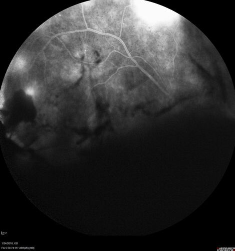 PDR and Vitreous hemorrhage - Second FA is following PRP laser
42 year old man (date 2018): Prior to 2 months ago the vision in the right eye was good.  This started with a glob in the vision and then the vision got better.  Then the string came back down and is getting bigger and bigger.  The last time he had bleeding in the left eye he had surgery in 2009.  The left eye is now doing OK other than there is a cataract.  The right eye had some laser treatment done in 2009.  The vitrectomy and laser were done at William Beaumont.  
VA OD: sc3'/200 NscUnable
VA OS: sc20/40 NscJ2-1
