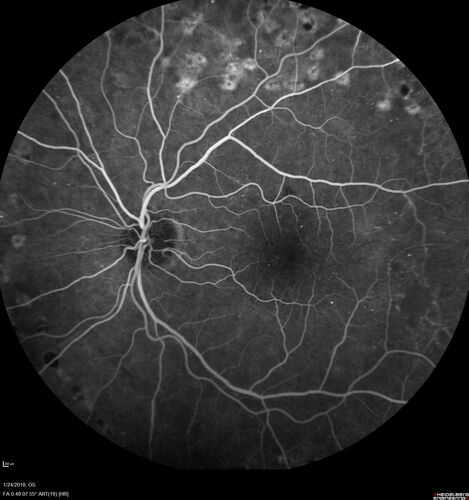 PDR and Vitreous hemorrhage - Second FA is following PRP laser
42 year old man (date 2018): Prior to 2 months ago the vision in the right eye was good.  This started with a glob in the vision and then the vision got better.  Then the string came back down and is getting bigger and bigger.  The last time he had bleeding in the left eye he had surgery in 2009.  The left eye is now doing OK other than there is a cataract.  The right eye had some laser treatment done in 2009.  The vitrectomy and laser were done at William Beaumont.  
VA OD: sc3'/200 NscUnable
VA OS: sc20/40 NscJ2-1
