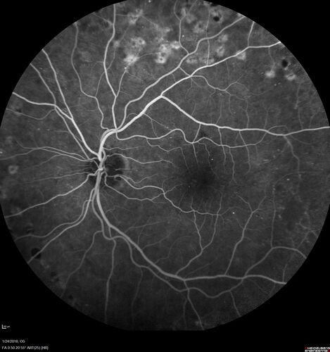 PDR and Vitreous hemorrhage - Second FA is following PRP laser
42 year old man (date 2018): Prior to 2 months ago the vision in the right eye was good.  This started with a glob in the vision and then the vision got better.  Then the string came back down and is getting bigger and bigger.  The last time he had bleeding in the left eye he had surgery in 2009.  The left eye is now doing OK other than there is a cataract.  The right eye had some laser treatment done in 2009.  The vitrectomy and laser were done at William Beaumont.  
VA OD: sc3'/200 NscUnable
VA OS: sc20/40 NscJ2-1
