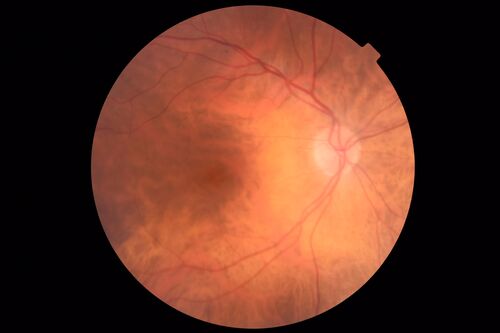 Subretinal Fluid - Inferior to the Nerve - Probable occult nerve pit
82 year old female. History of visual 