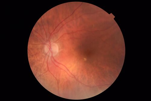 Subretinal Fluid - Inferior to the Nerve - Probable occult nerve pit
82 year old female. History of visual 