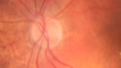 Subretinal Fluid - Inferior to the Nerve - Probable occult nerve pit
82 year old female. History of visual 