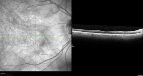 Subretinal Fluid - Inferior to the Nerve - Probable occult nerve pit
82 year old female. History of visual 