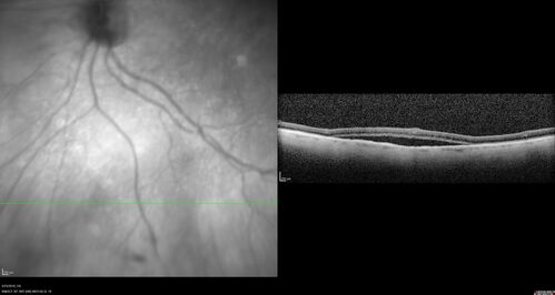 Subretinal Fluid - Inferior to the Nerve - Probable occult nerve pit
82 year old female. History of visual 
